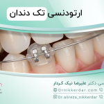 ارتودنسی تک دندان: ایا میشود فقط یک دندان را ارتودنسی کرد؟