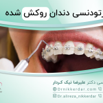 ارتودنسی دندان روکش شده: آیا ارتودنسی دندان روکش دار امکان پذیر است؟