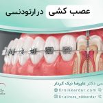عصب کشی دندان در ارتودنسی، نحوه انجام (قبل، حین و بعد)